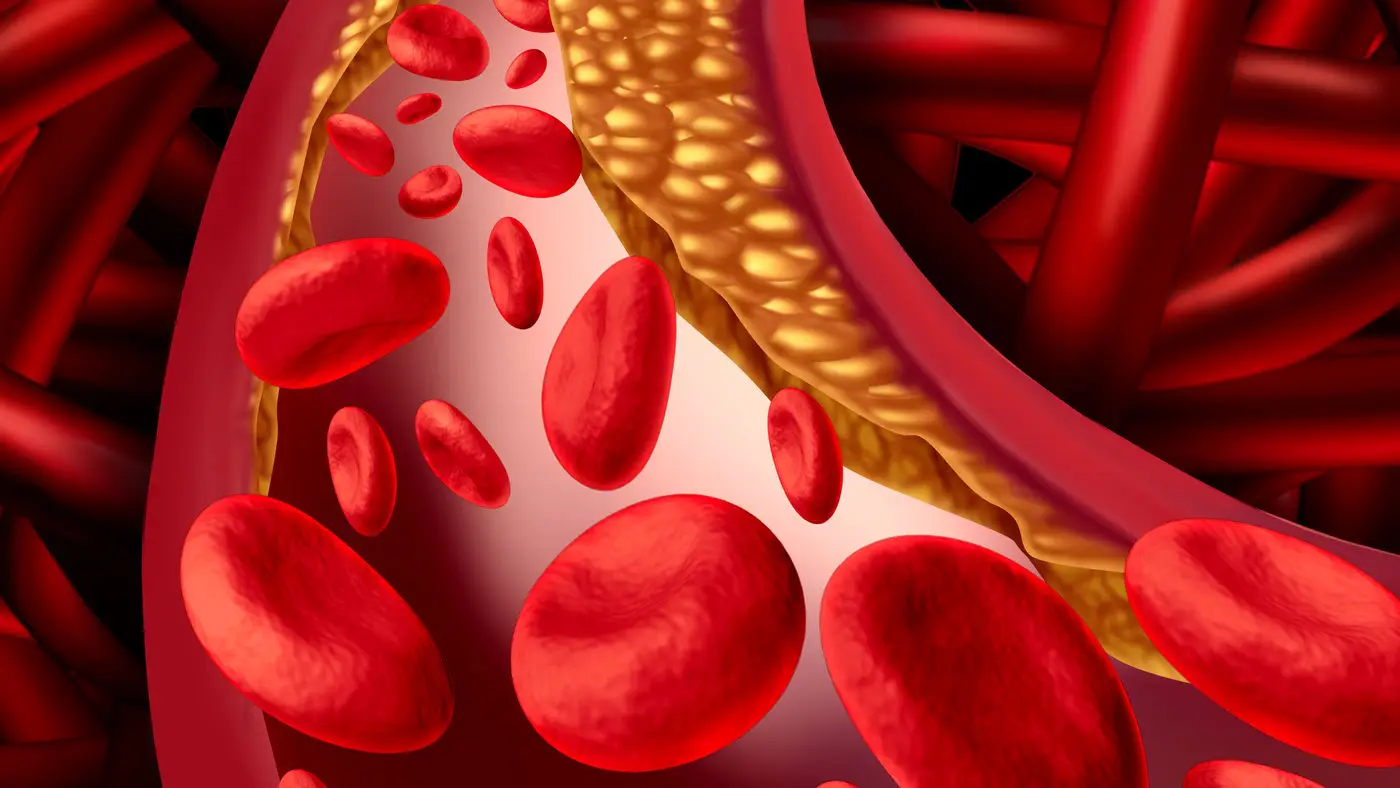 Vene varicose, quali sono i rimedi naturali? L’abitudine quotidiana per migliorare la circolazione